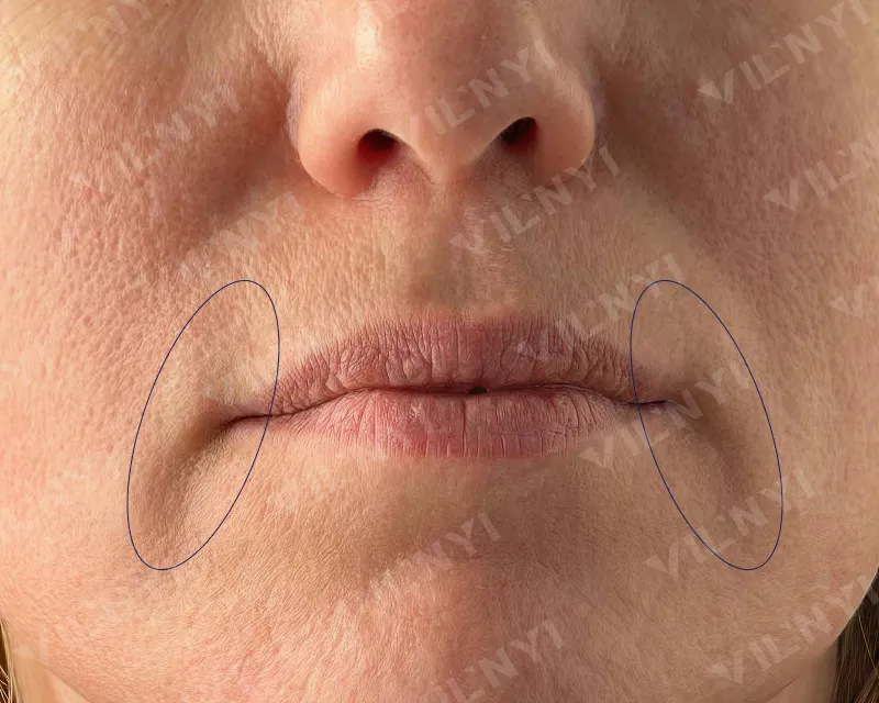 ДО · Botox