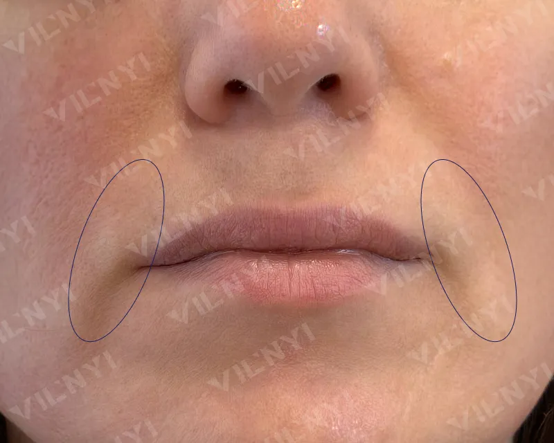 ПІСЛЯ · Botox