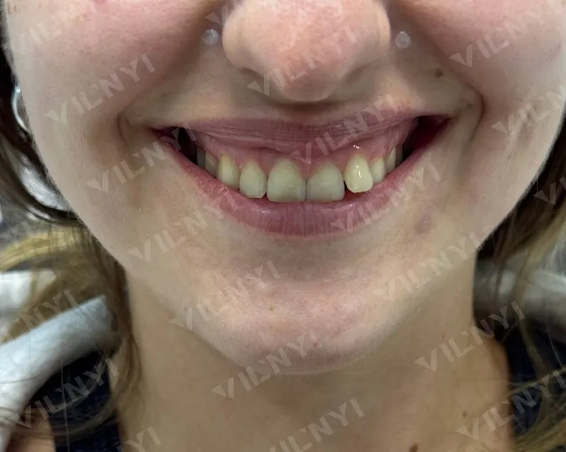 ДО · Botox