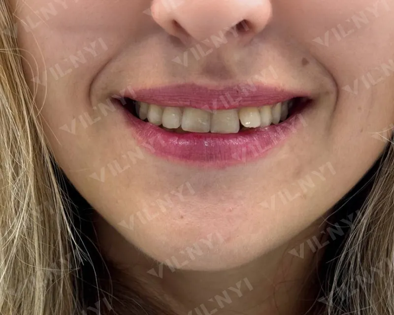 ПІСЛЯ · Botox